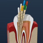 Dentistionline – Endodonzia clinica: soluzioni semplici per una endodonzia predicibile