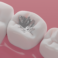 Dentistionline – Nuovo corso: “Le caratteristiche dell’amalgama dentale e la sua corretta rimozione”
