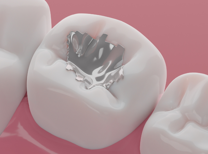 Dentistionline – Nuovo corso: “Le caratteristiche dell’amalgama dentale e la sua corretta rimozione”